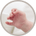 Birth Defects of hands