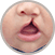 Cleft Lip and Cleft Palate
