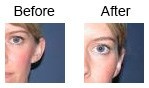 Ear Correction
