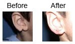 Ear Correction