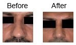 Nose Correction