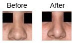 Nose Correction