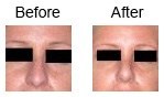 Nose Correction