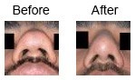 Nose Correction