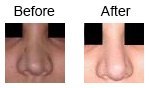 Nose Correction