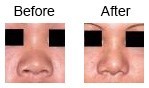 Nose Correction