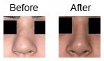 Nose Correction