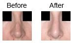 Nose Correction