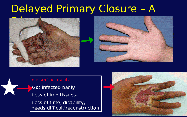 Primary Wound Care