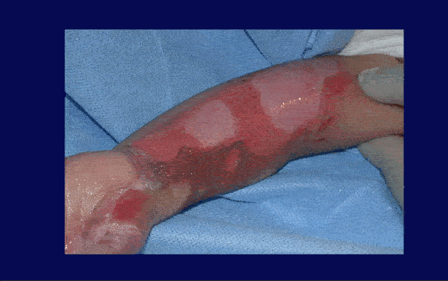 Primary Wound Care